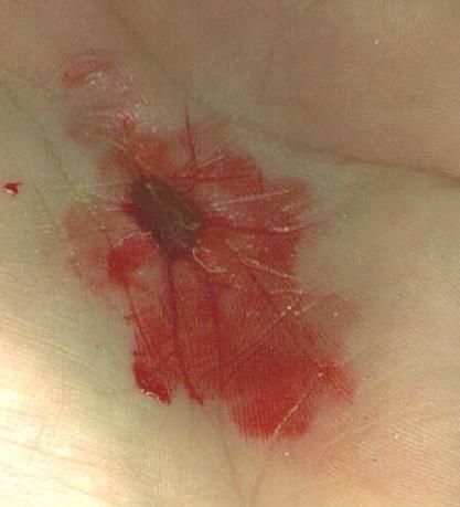 Stigmata wound